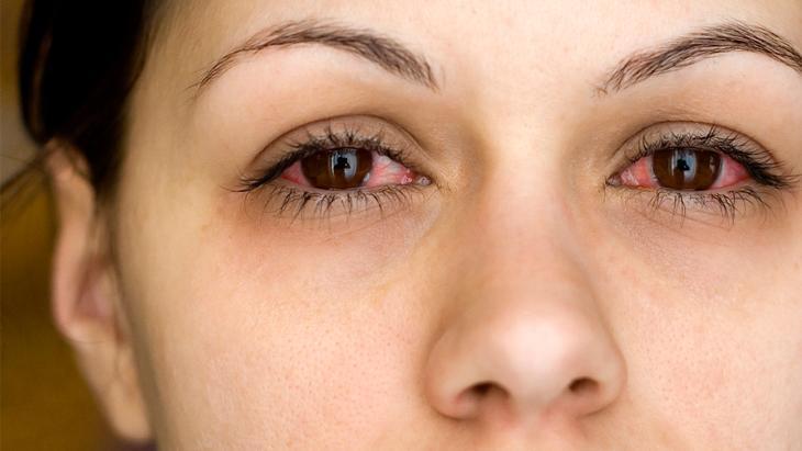 kis sogugu gozu de vuruyor bulasici olabiliyor belirti varsa bunlari yapin acclGhnB.jpg